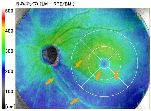 前視野緑内障に向き合う―PPGを発見した時、どう考え管理するか