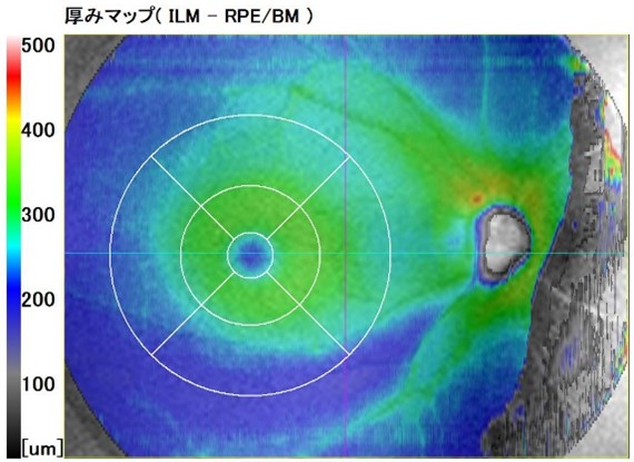 前視野緑内障に向き合う PPGを発見した時，どう考え管理するか